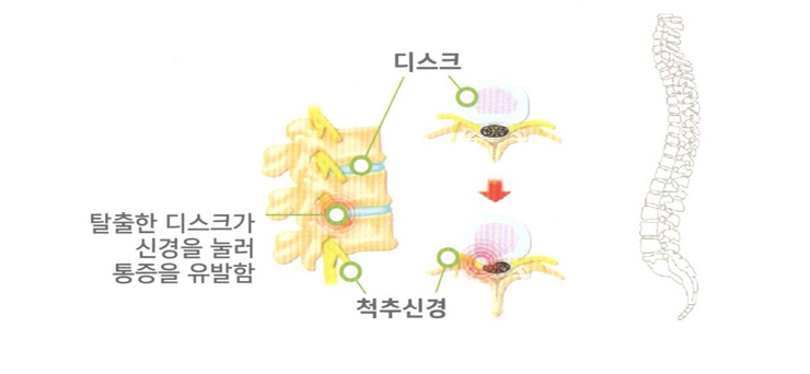 신경성형술로 좋은 효과를 보는 경우