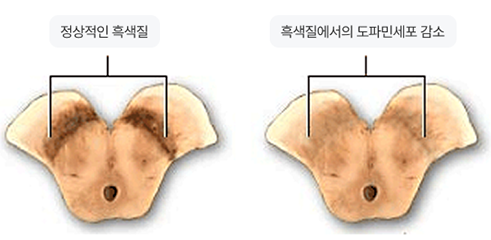임상증상
