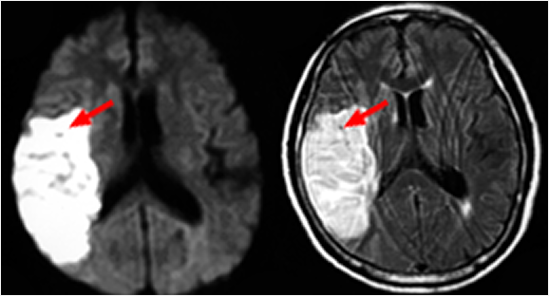 뇌경색 뇌MRI