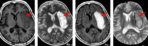 수술 전 MRI